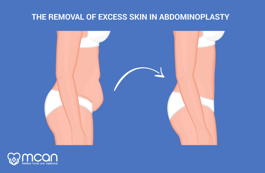 Buikwandcorrectie in Turkije Abdominoplastie MCAN Health