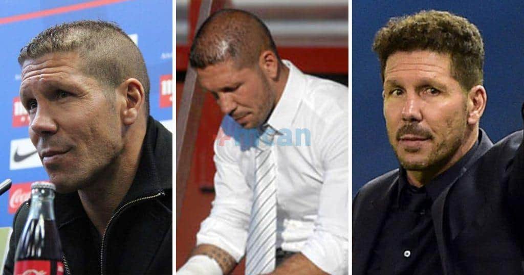 6 famosos con implante capilar 5 diego simeone implante capilar min diego simeone implante capilar min