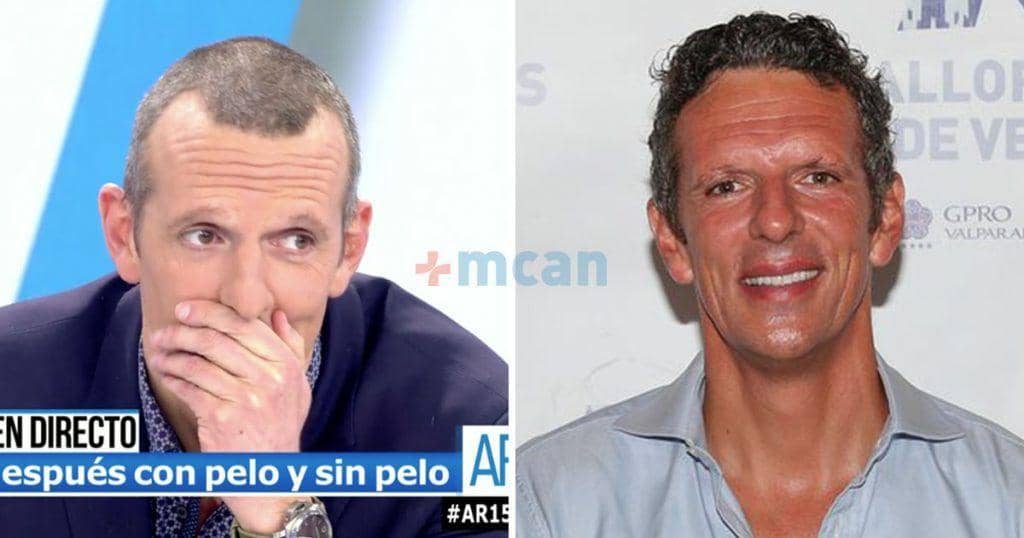 6 famosos con implante capilar 9 joaquin prat transplante capilar min joaquin prat transplante capilar min