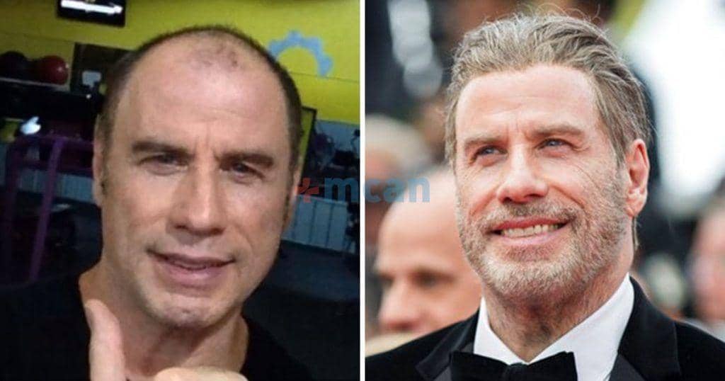 6 famosos con implante capilar 4 john travolta implante capilar min john travolta implante capilar min