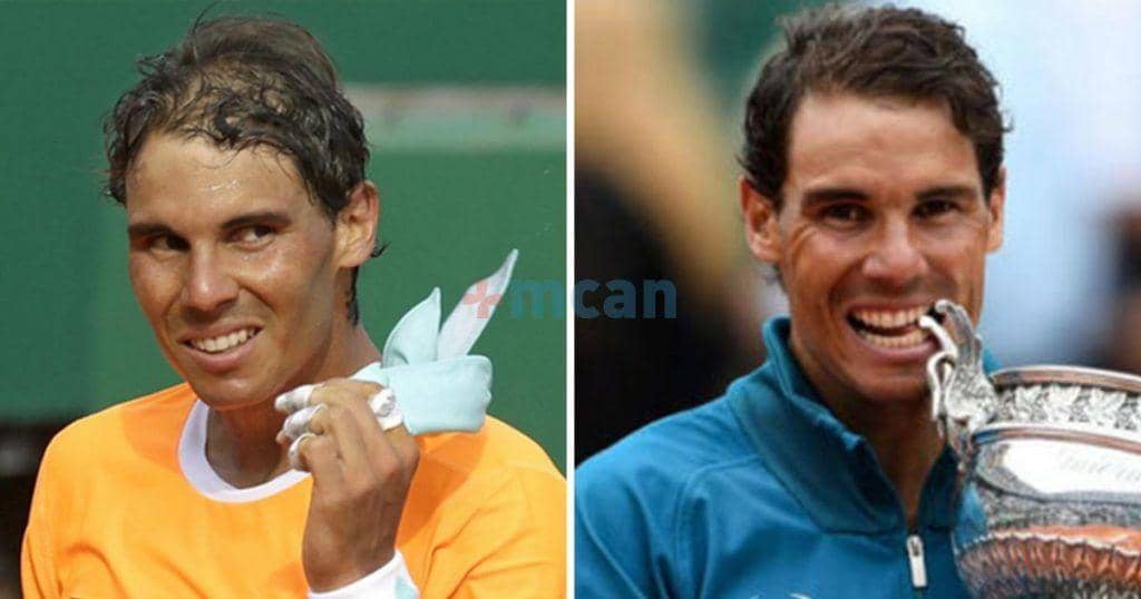 6 famosos con implante capilar 7 nadal transplante capilar min nadal transplante capilar min