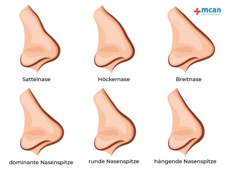 Nasen Op Türkei Rhinoplastik Nasenkorrektur MCAN Health
