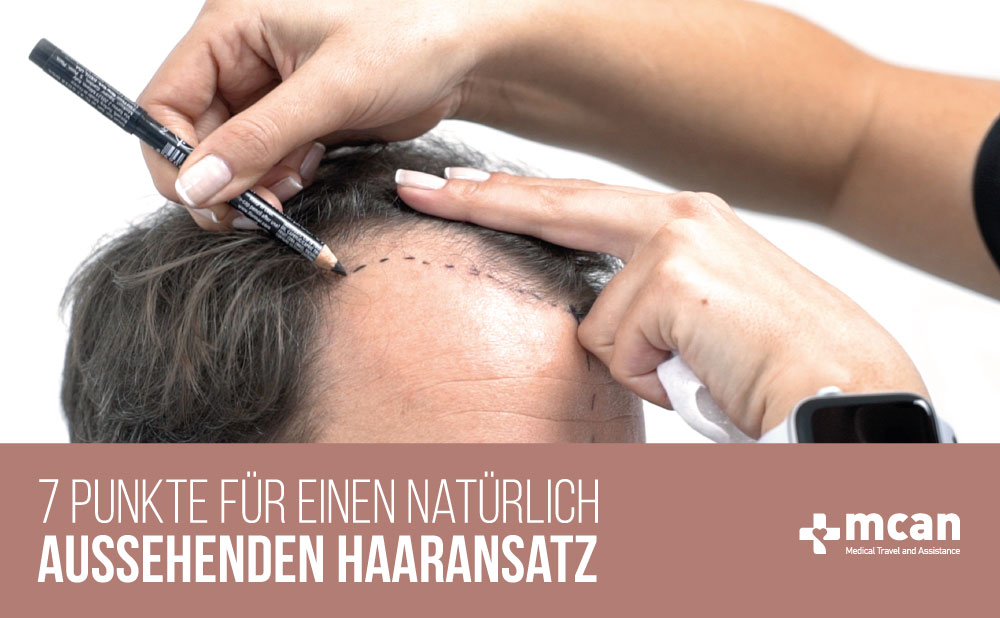 natürlich aussehenden Haaransatz bei Haartransplantationen