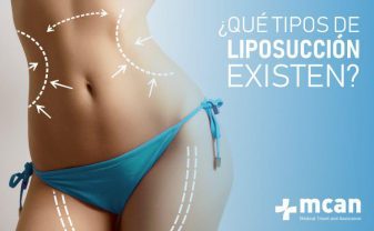 ¿Qué tipos de liposucción existen?