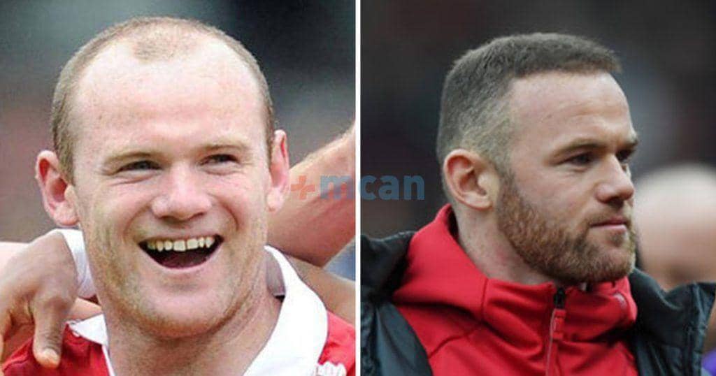 6 famosos con implante capilar 6 rooney transplante capilar min rooney transplante capilar min