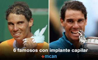 seis famosos con implante capilar blog