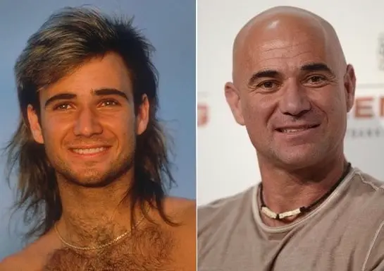Andre Agassi Haarausfall