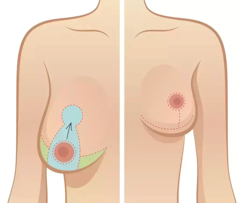 Bruststraffung und Brustimplantate