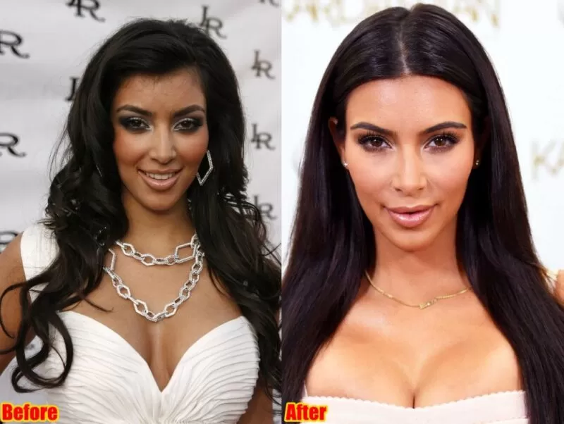 Gesichtsfüller von Kim Kardashian