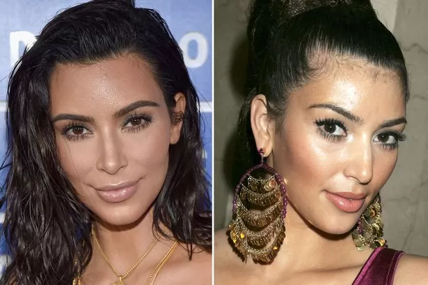 Kim Kardashian Nasenkorrektur – Vorher und Nachher
