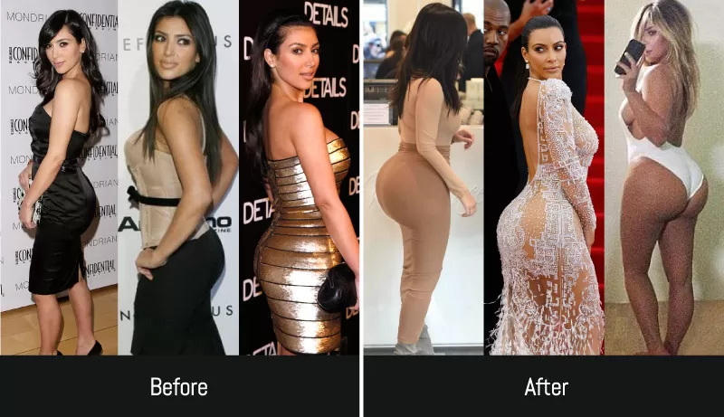 Kim Kardashian Po-Implantate vorher und nachher