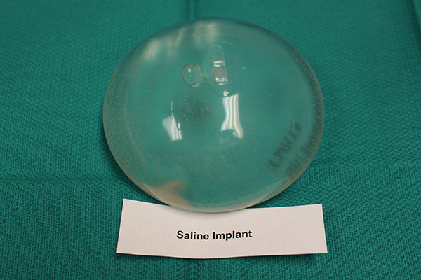 Kochsalzhaltige Implantate
