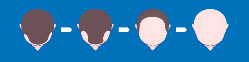 Men's Hair Loss Type