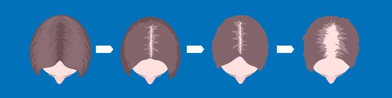 Women's Hair Loss Type