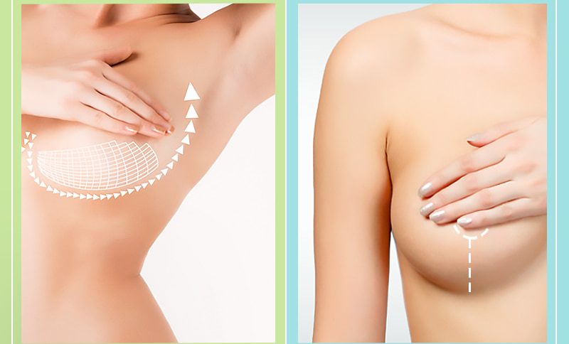 kombinierten Brustvergrößerung mit Bruststraffung