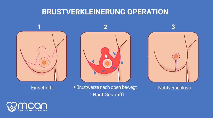 brustverkleinerung-turkei-operation