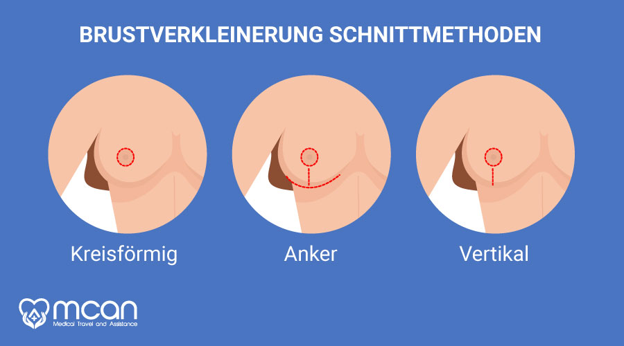 brustverkleinerung-turkei-schnittmethoden