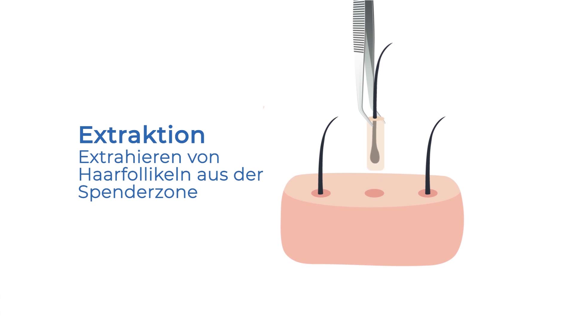 fue haartransplantation