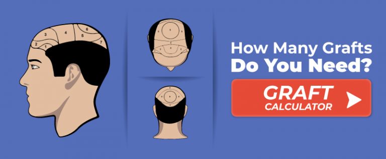 Hair Graft Calculator