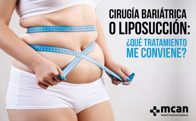 Cirugía bariátrica o liposucción: ¿cuál me conviene?