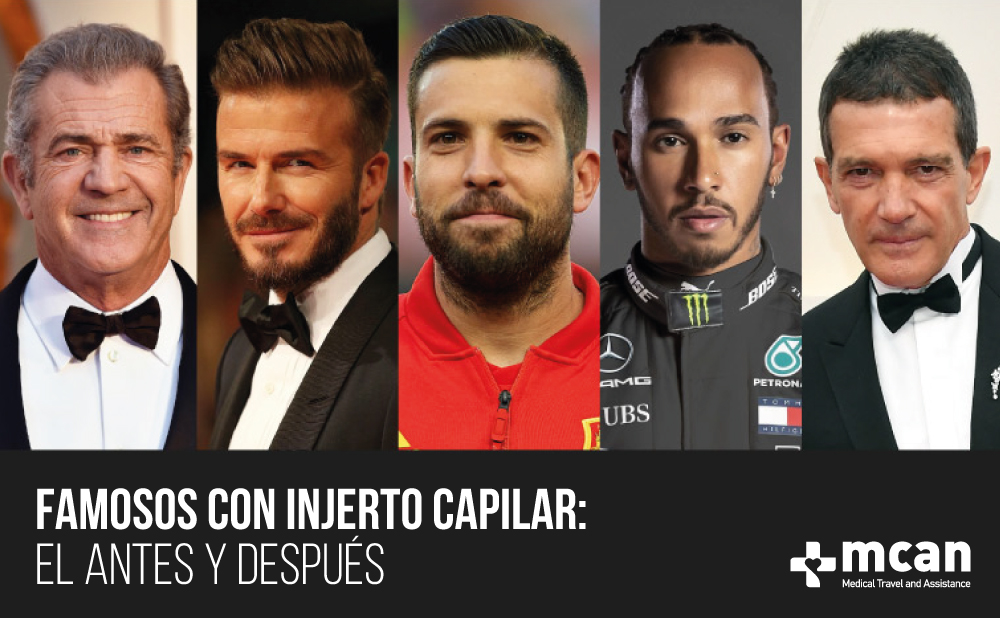 Famosos con injerto capilar | MCAN Health Blog