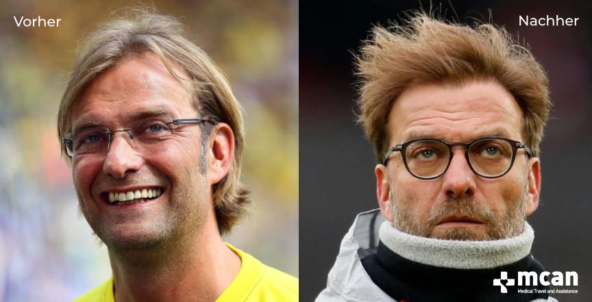 Jürgen Klopp Haartransplantation vorher und nachher