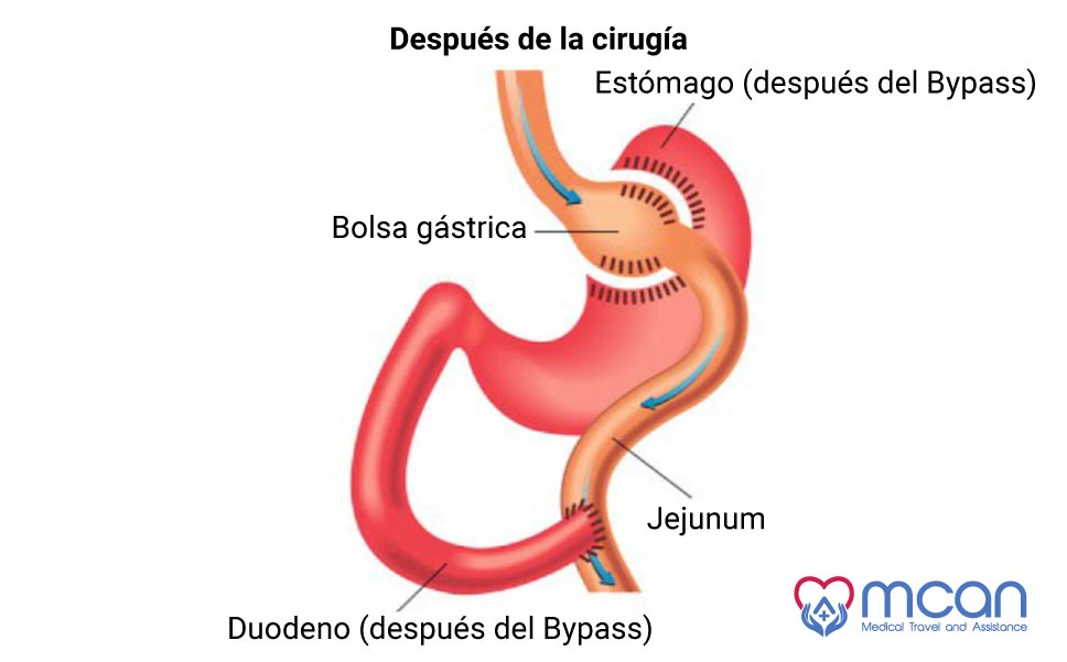 Preguntas frecuentes sobre la cirugía bariátrica ByPass Gástrico