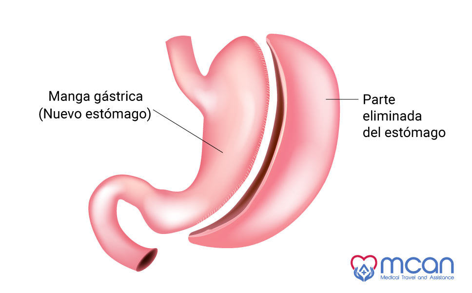 preguntas frecuentes sobre la manga gástrica