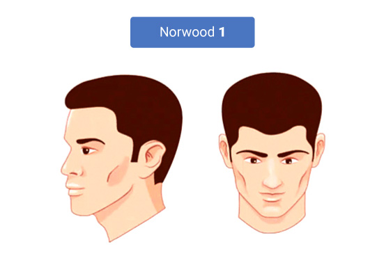 The Stages of Norwood Hamilton Scale 1