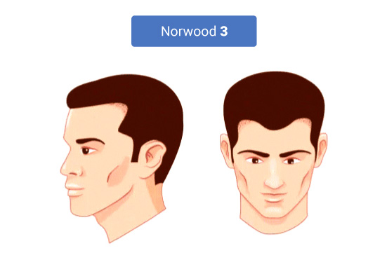 The Stages of Norwood Hamilton Scale 3