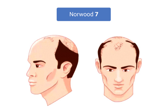 The Stages of Norwood Hamilton Scale 7