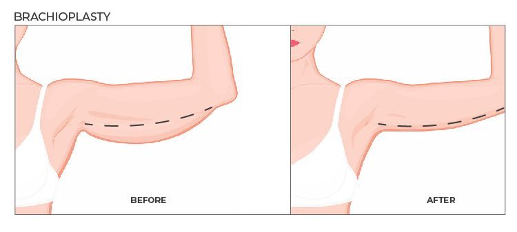 arm lift skin removal before after weight loss surgery e1654531721888