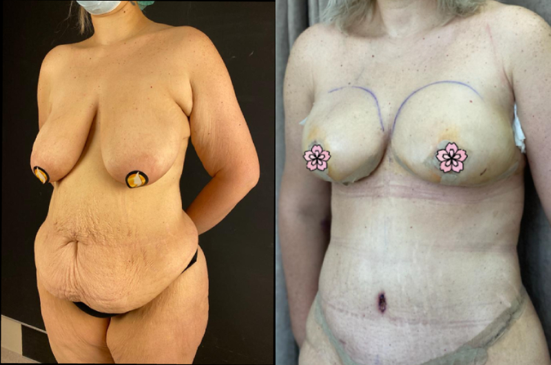 breast lift after weight loss surgery 