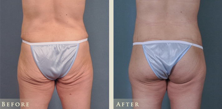 BBL after weight loss surgery BBL after weight loss surgery