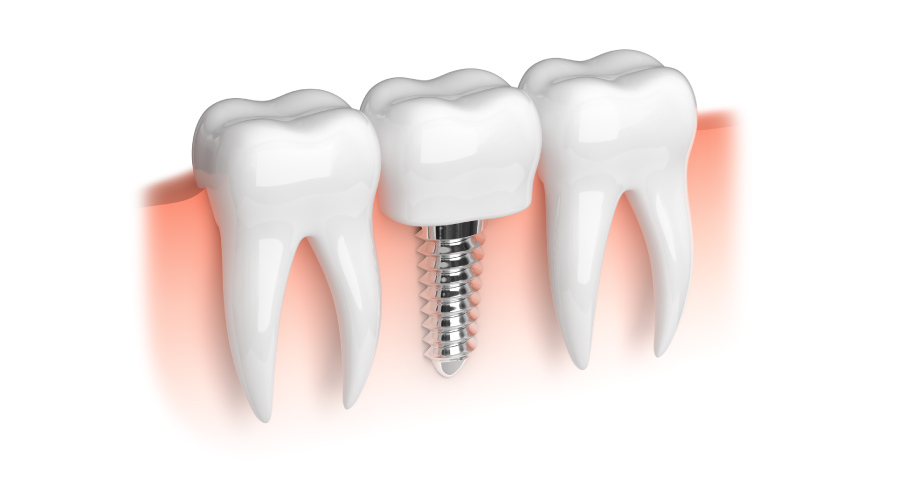 İmplantaten in Turkije | Tand | MCAN Health