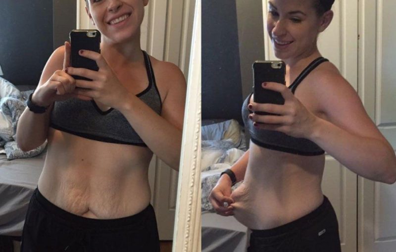 loose skin after weight loss surgery loose skin after weight loss surgery