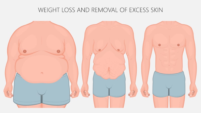 weight loss and removal of excess skin 