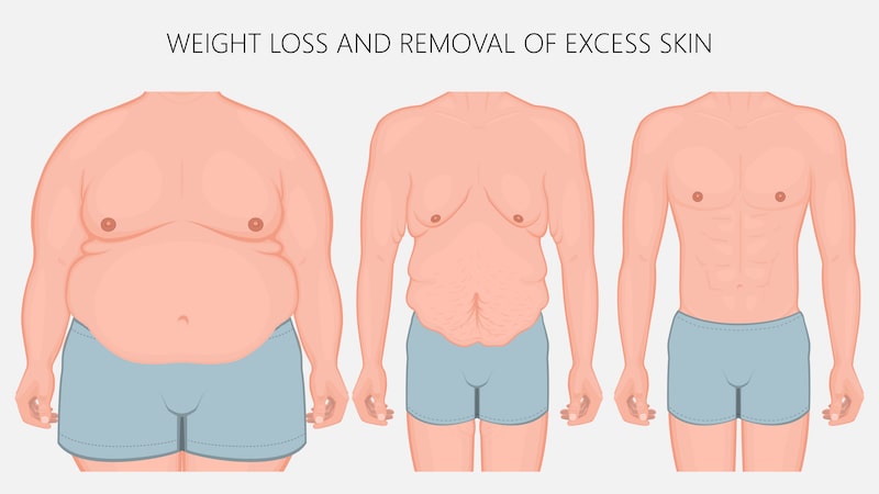 weight loss and removal of excess skin weight loss and removal of excess skin