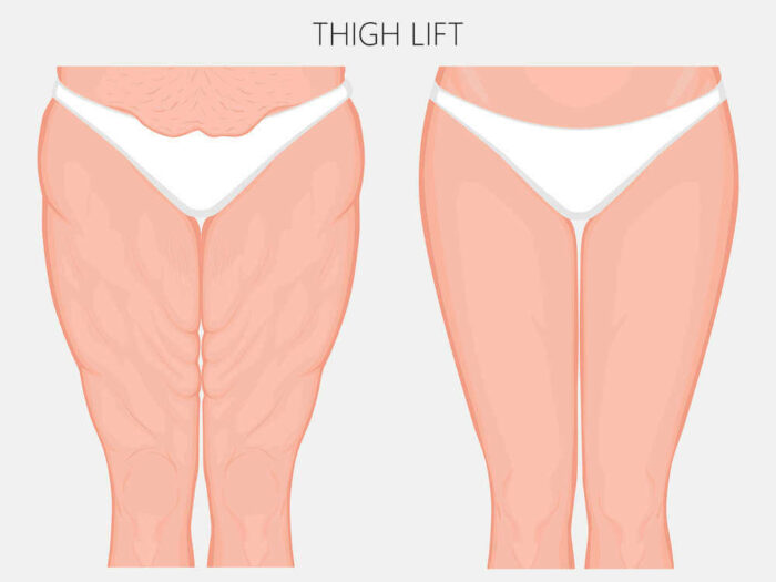 thigh lift after weight loss surgery