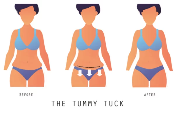 Tummy Tuck After Weight Loss 