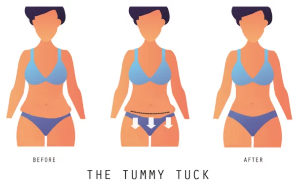 Tummy Tuck After Weight Loss Tummy Tuck After Weight Loss