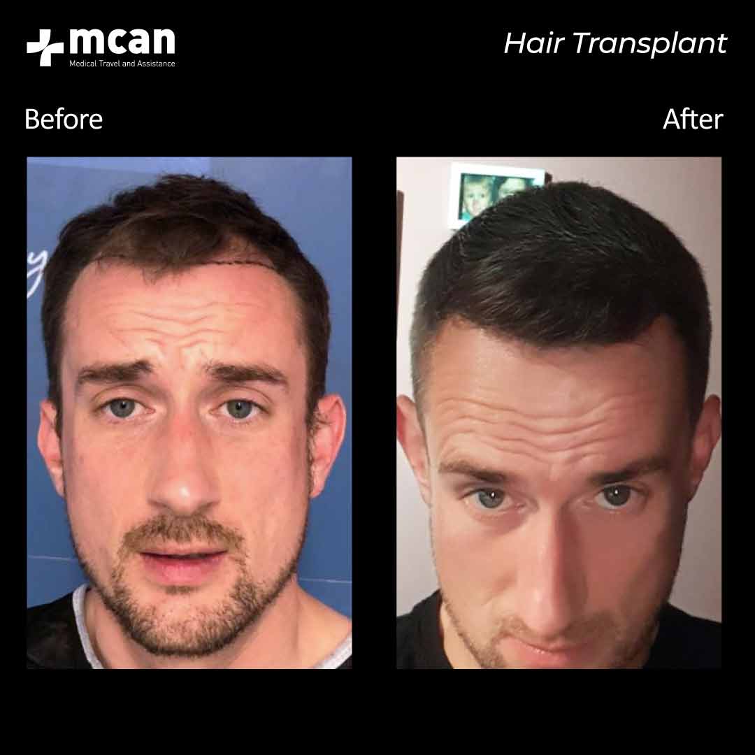 01.09.20 hair transplant 2