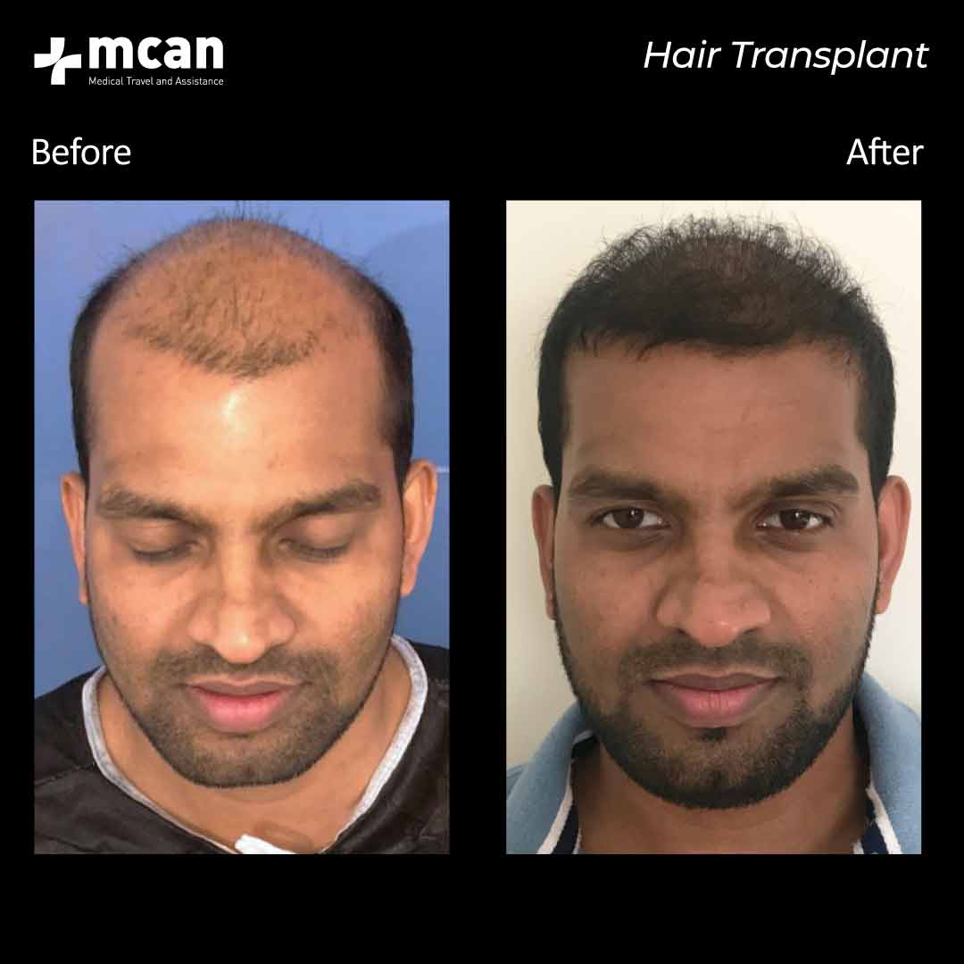 01.09.20 hair transplant 3