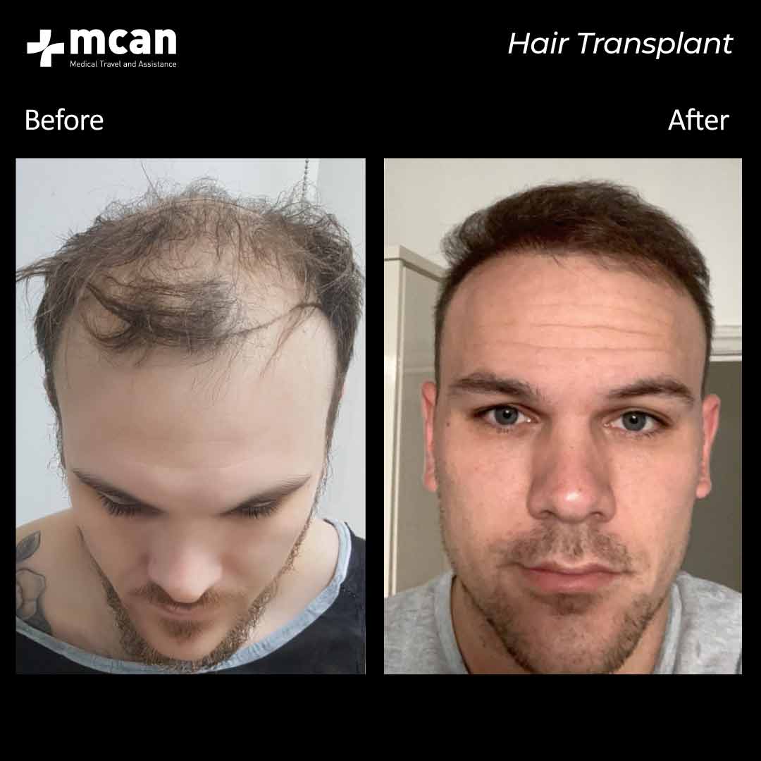 09.09.20 hair transplant
