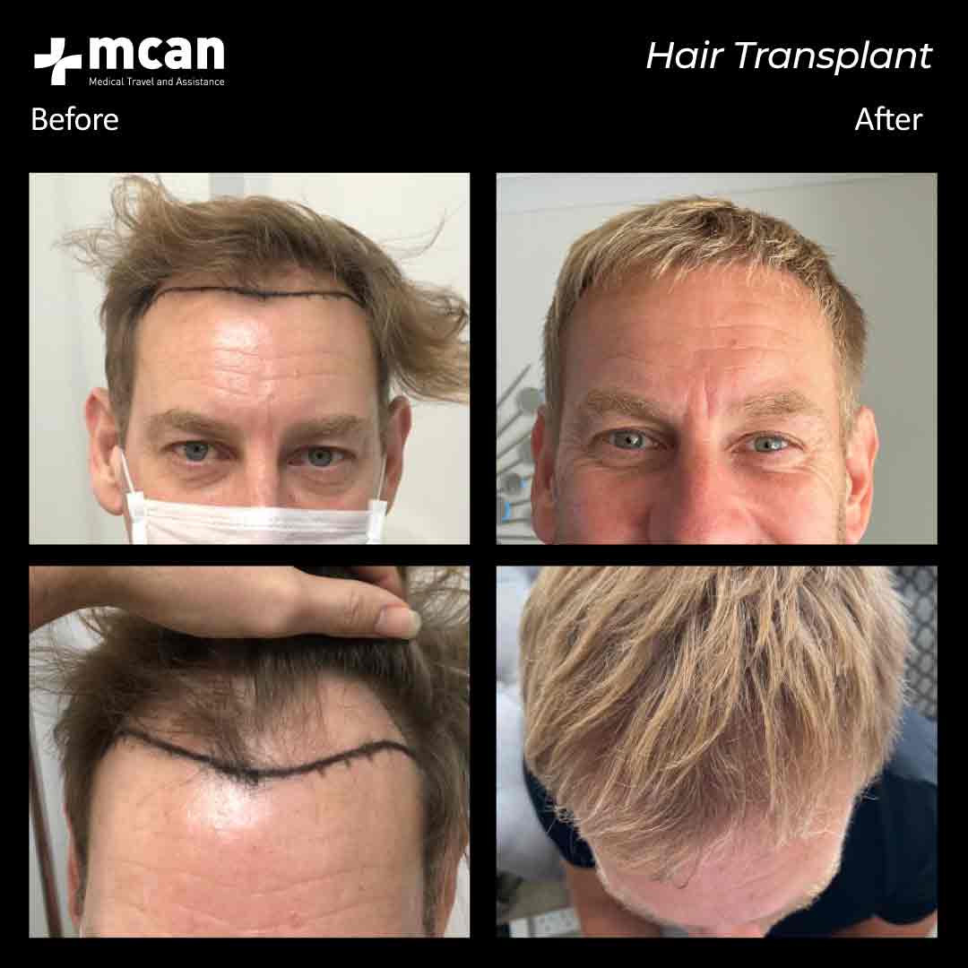 11.08.20 hair transplant