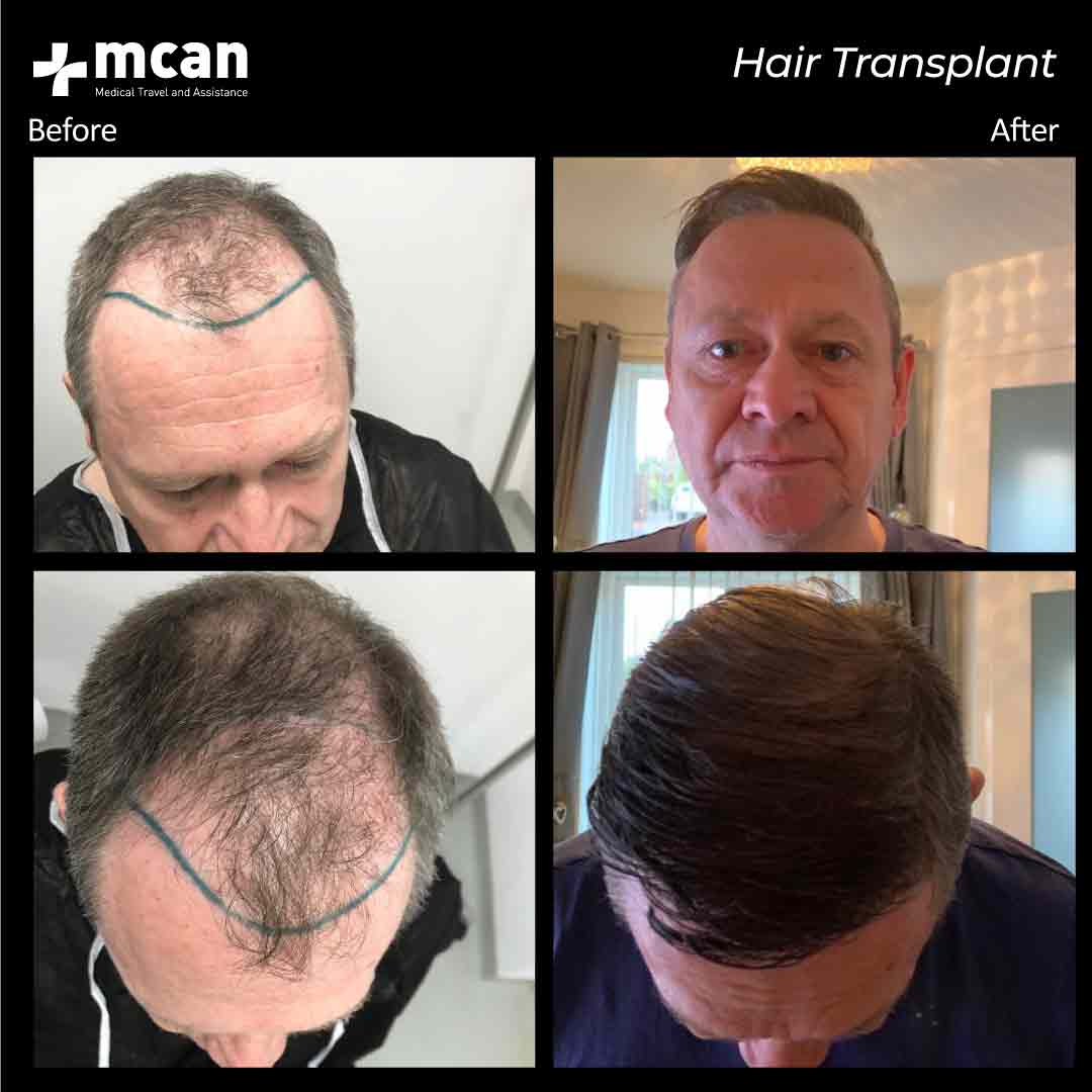 15.12.2020 hair transplant before after