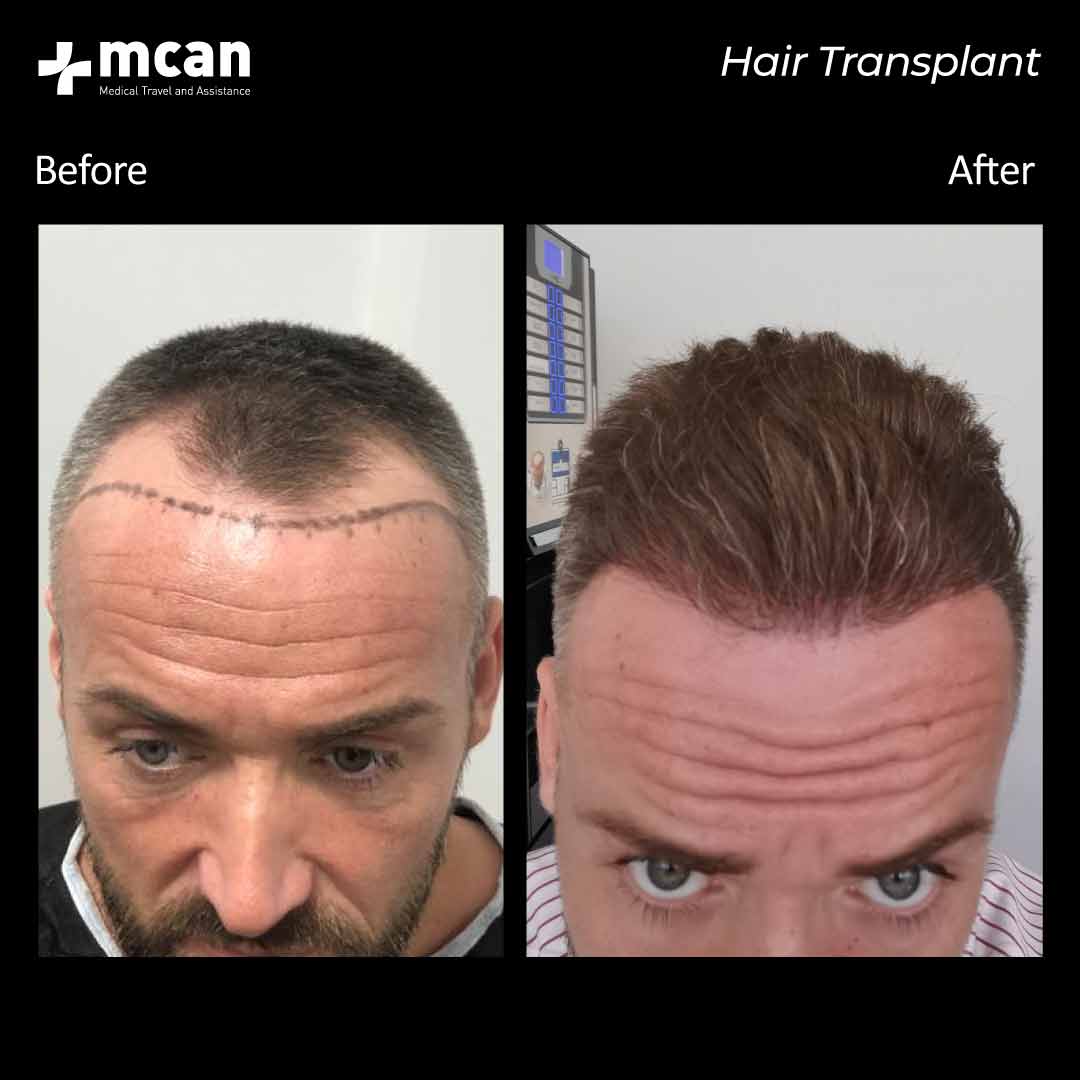 17.08.20 hair transplant