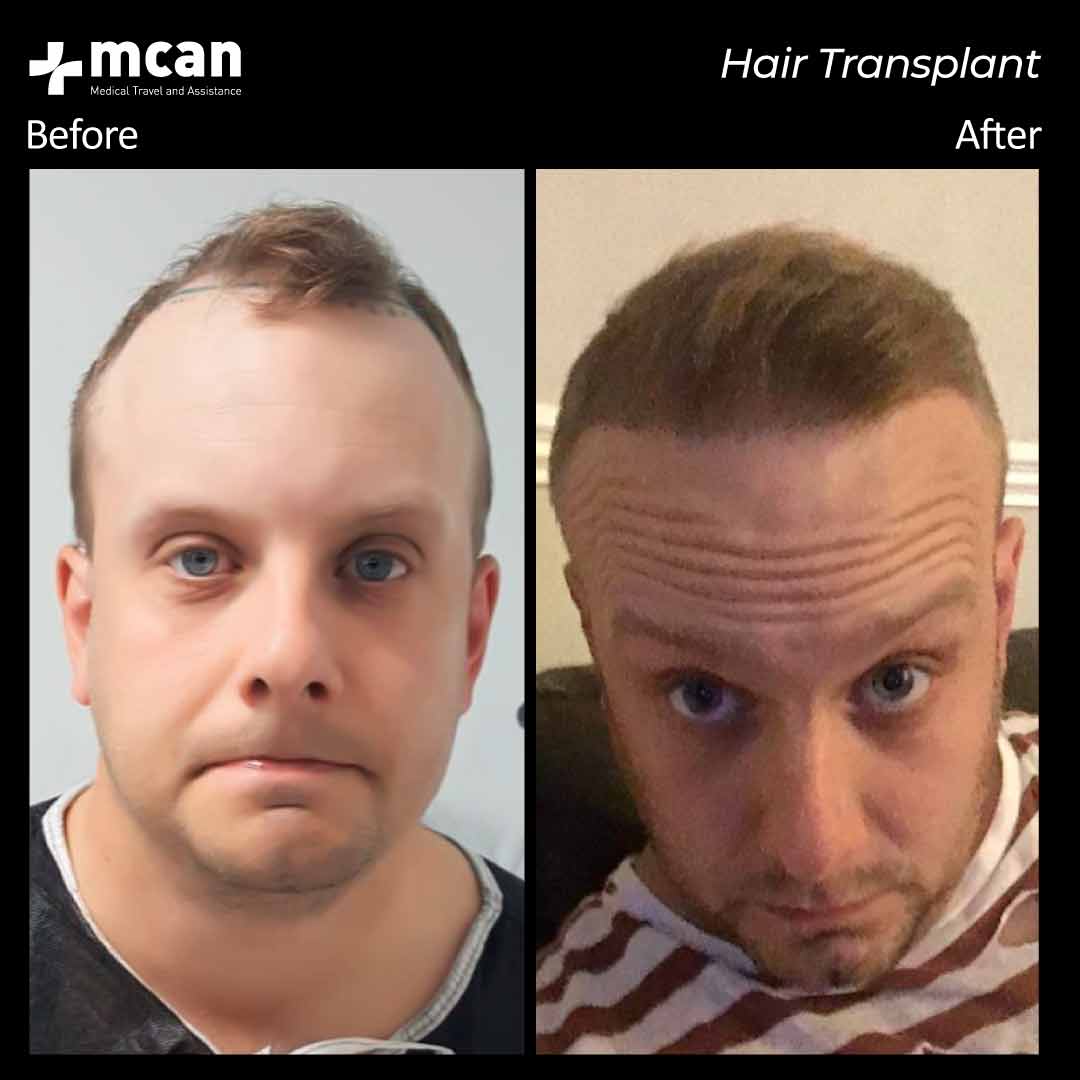 19.11.20 hair transplant 1
