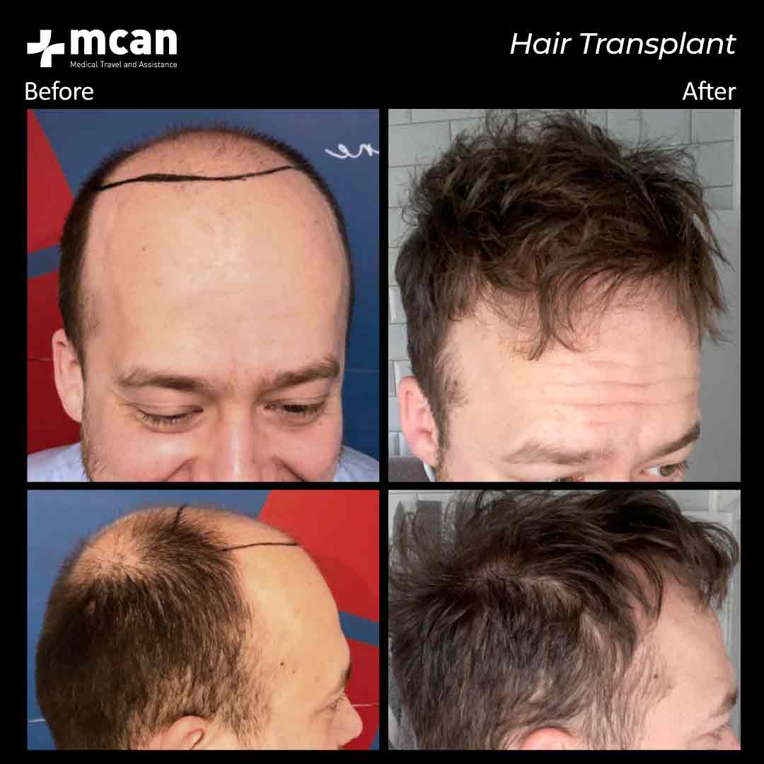 19.11.20 hair transplant 4
