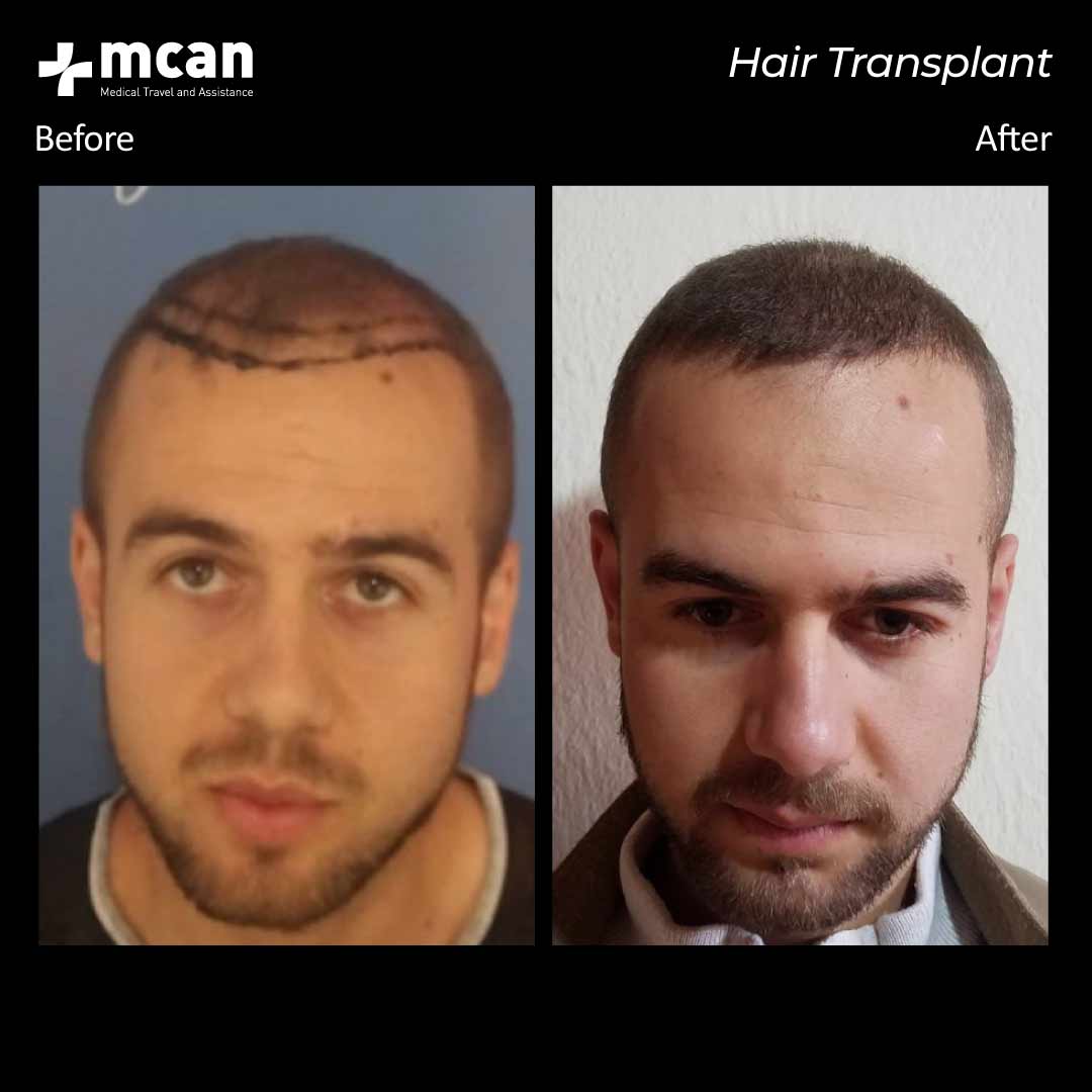 27.11.20 hair transplant 1